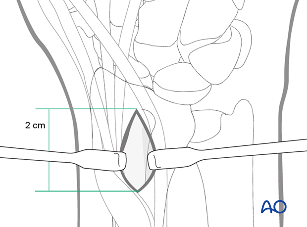 Making a longitudinal incision proximal to Lister’s tubercle during harvest of bone for grafting