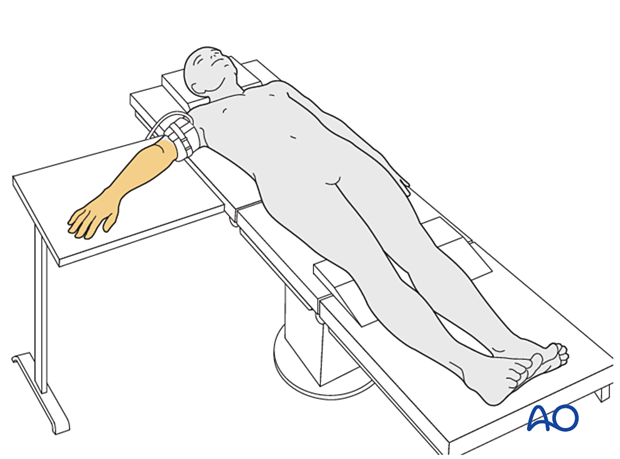 The entire hand, wrist, and arm are disinfected right up to the limits of the tourniquet cuff for operative treatment of a carpal injury