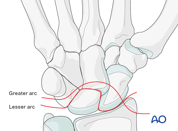 The greater and lesser arcs can help to identify the location and extent of a complex carpal injury.