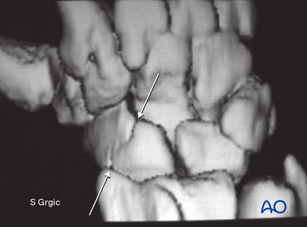 3-D CT rendering shows fracture and its relation to the lunate and capitate in a case of suspected scapholunate fracture-dislocation. The arrows indicate the scaphoid fracture from the dorsal aspect.