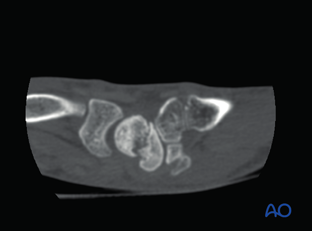 Nonbridging healing of carpal bones