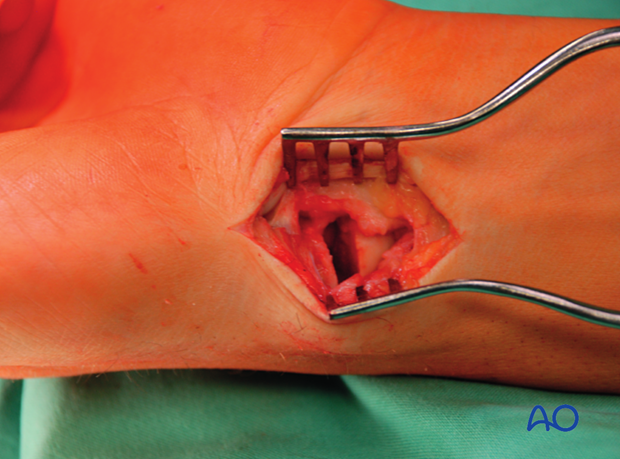 Management of nonunion of carpal bones - nonunion resection