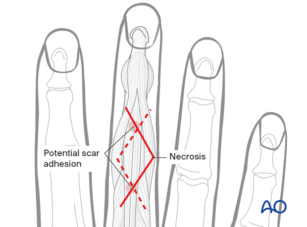 Zigzag skin incision of the 3rd proximal interphalangeal joint showing scar adhesion and necrotic sites