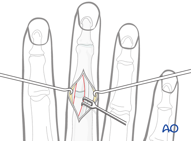 Retraction of lateral band using paratendon approach to the 3rd proximal interphalangeal joint