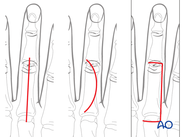 Dorsal approach to the 3rd proximal interphalangeal joint – alternative skin incisions