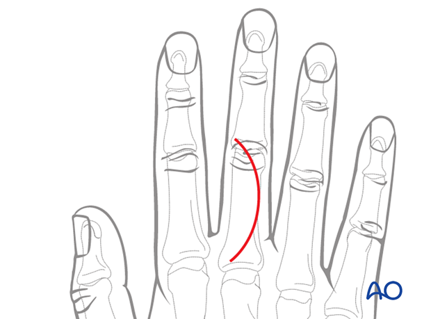 Curved skin incision of the 3rd proximal interphalangeal joint