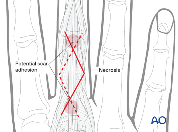 Zigzag skin incision of the 3rd proximal interphalangeal joint showing scar adhesion and necrotic sites