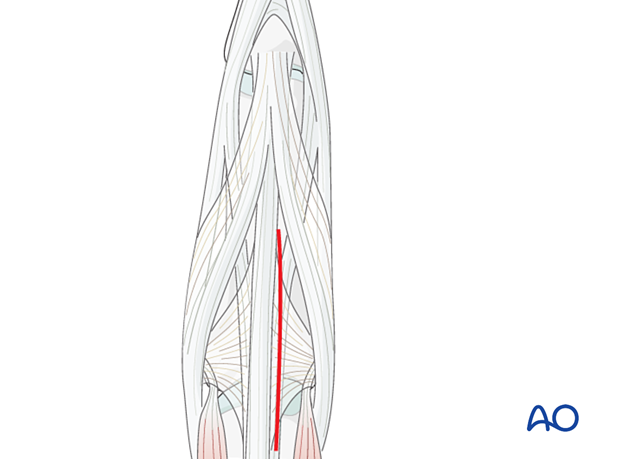 73 A020 Dorsal approach to the proximal phalanx