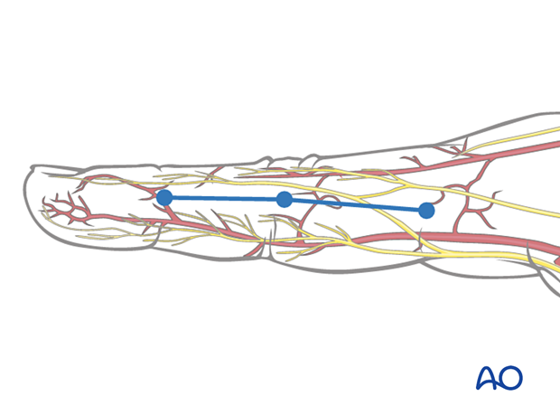 Skin marking indicates line safe for incision with vascular system – midaxial approach to the proximal interphalangeal joint