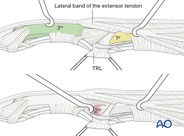 Retraction of the dorsal fringe of the transverse retinacular ligament fringe to develop three windows