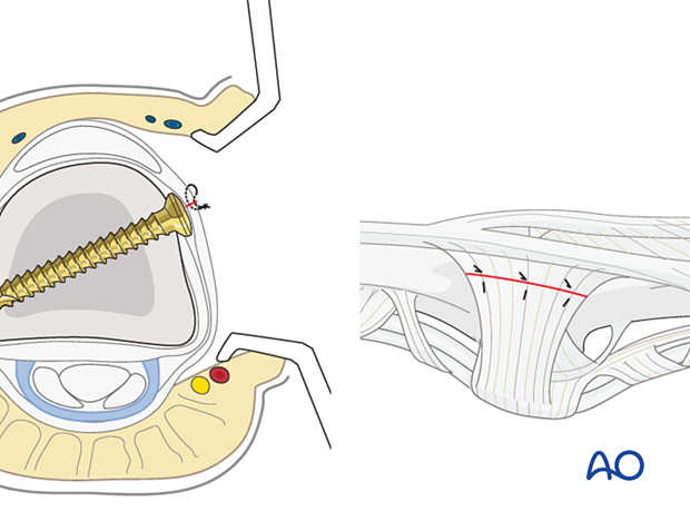 Implant covering with periosteum and transverse retinacular ligament repair with fine mattress sutures – proximal interphalangeal joint