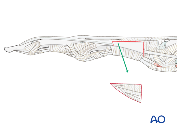 Resection of the oblique fibers of the lateral band – proximal phalanx