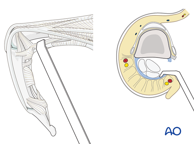 Palmar access to the volar aspect of the proximal phalangeal shaft