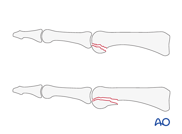 Proximal phalanx distal end fractures - hand