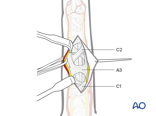 Mobilized digital arteries and nerves after skin flap elevation and apex retraction