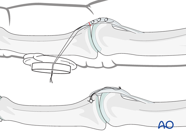 Volar plate reattachment by pullout suture or anchor sutures