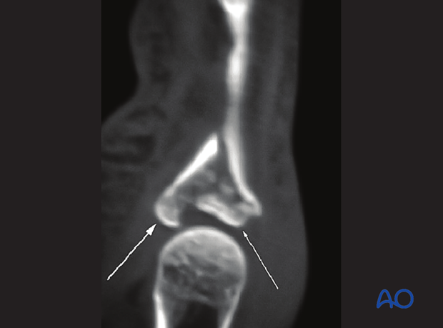 X-rays of an articular fracture of the proximal phalangeal base