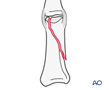 Distal end segment articular