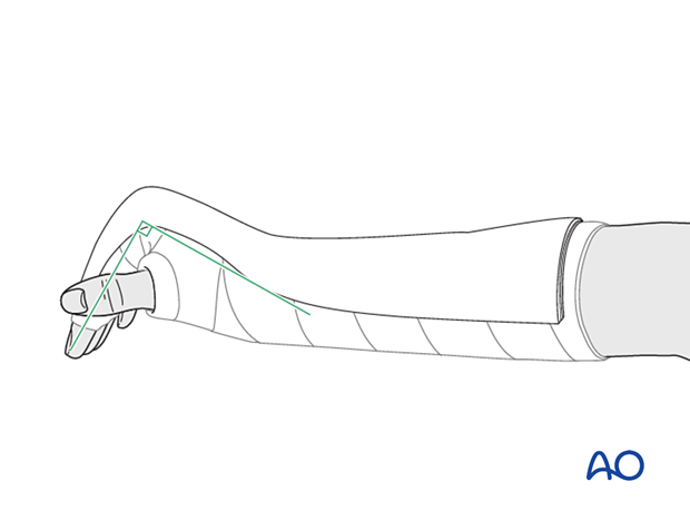 Splint of at least 6 cast bandage slabs applied in 15° extension covers the dorsal half of the forearm, wrist, and hand.