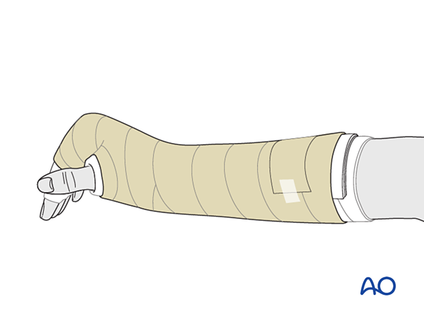 The splint is held in place with an elastic bandage.