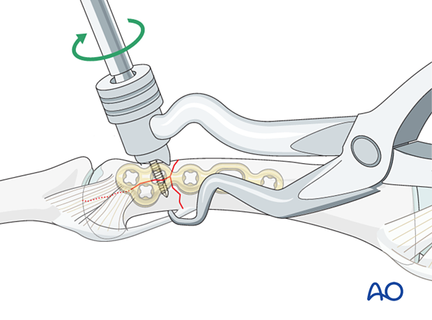 Fixation of a complete articular fracture of the proximal phalangeal head by inserion of a screw in the articular block