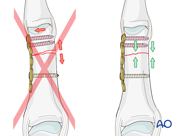 Compression plating of transverse fracture of the proximal phalangeal head