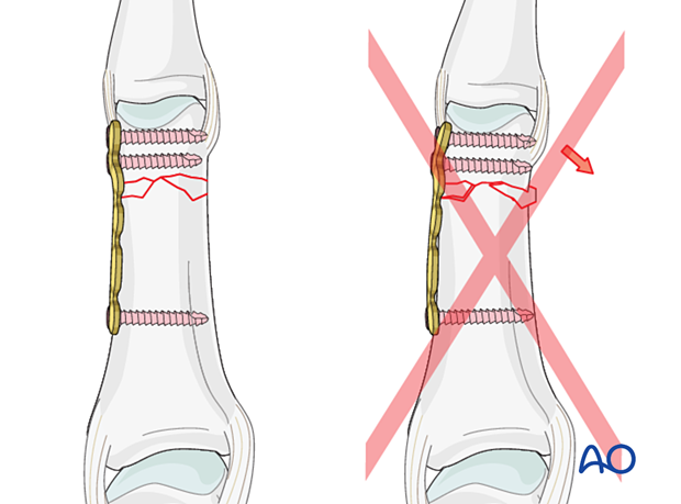 Bridge plating of a multifragmentary extraarticular fracture of the proximal phalangeal head