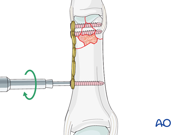 Plate fixation of a complete articular fracture of the proximal phalangeal head – insertion of a screw in the diaphysis