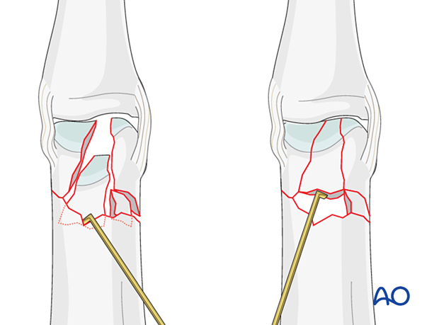 Reduction of a complete articular fracture of the proximal phalangeal head with a dental pick