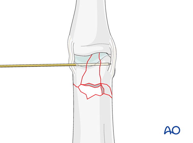 Holding the reduction of a complete articular fracture of the proximal phalangeal head with a K-wire