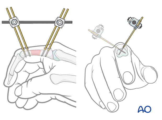 External fixation of diaphyseal wedge or multifragmentary fractures – proximal phalanx – hand.