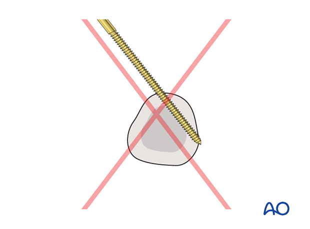 Eccentric K-wire positioning is incorrect for external fixation of diaphyseal wedge or multifragmentary fractures – proximal phalanx – hand.