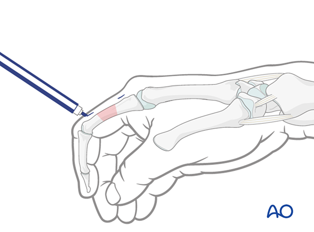 Marking the insertion points on the skin – external fixation of diaphyseal wedge or multifragmentary fractures – proximal phalanx – hand