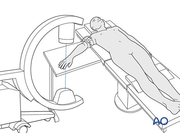 Patient place supine with the arm on a hand table and C-arm coming from laterally