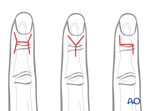 Dorsal approach to the DIP joint