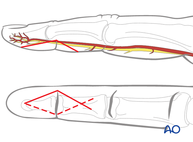 Palmar approach to the DIP joint