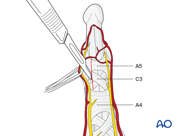 Division of the A5 and C3 pulleys during a palmar approach to the DIP joint