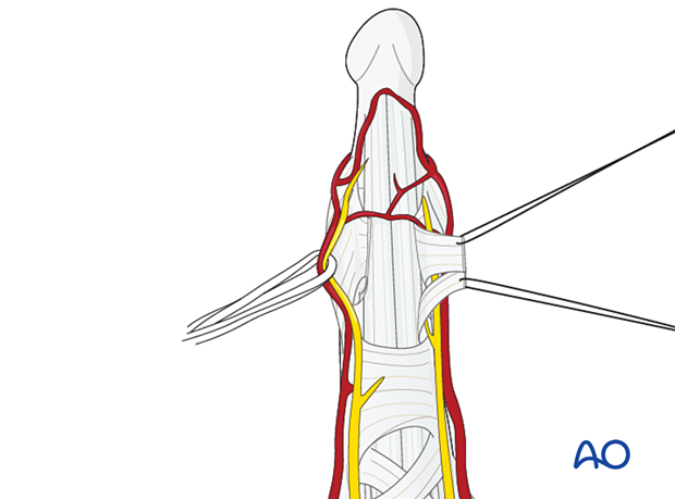 Elevation of the A5 and C3 pulley flaps during a palmar approach to the DIP joint