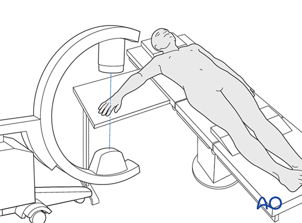 Patient in supine position with the arm on a side table and the C-arm