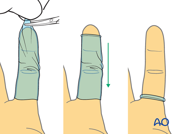 Application of a small tourniquet with a finger of a sterile glove