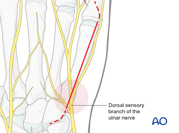 Skin incision of a dorsal approach to the 5th metacarpal