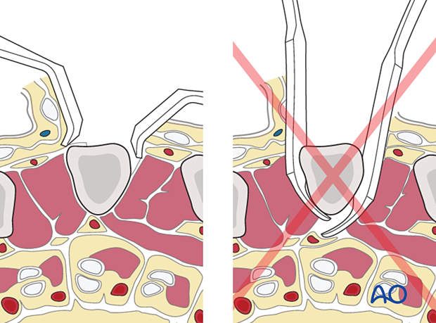 Use of Langenbeck retractors instead of Hohmann levers in a dorsal approach to the metacarpals