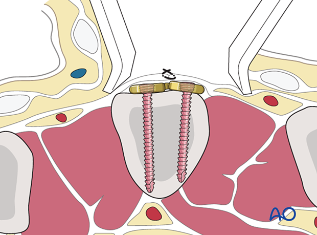 Plate covered with periosteum after fixation of a metacarpal fracture