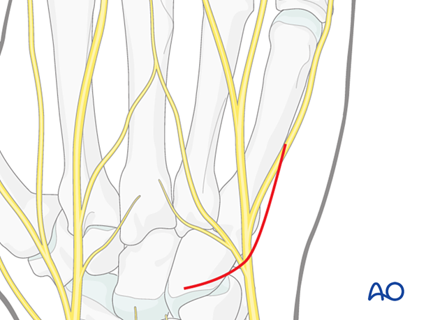 Skin incision of a dorsal approach to the 5th carpometacarpal joint