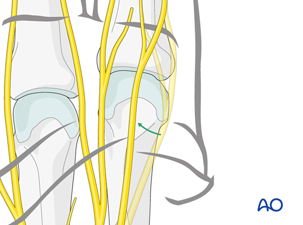 Digital nerve dislocation of the level of the metacarpal head