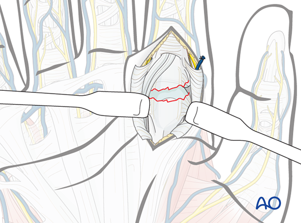 Exposure of the joint during a volar approach to the metacarpophalangeal joint of the 2nd ray