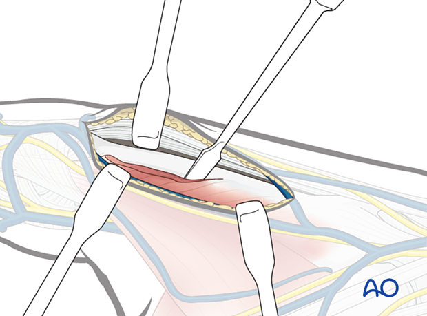 Retraction of extensor tendons during a radial approach to the 2nd metacarpal