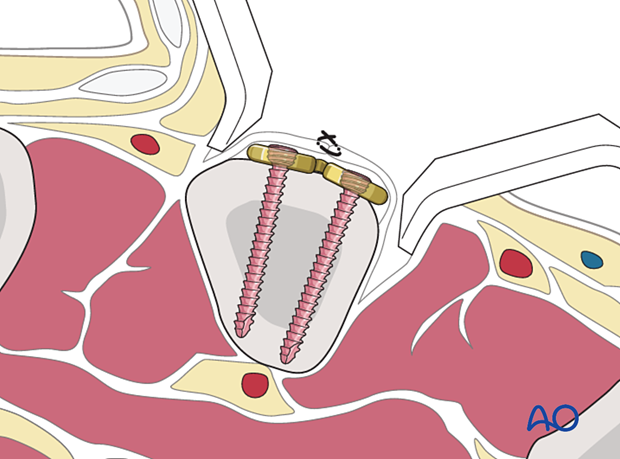 Periosteum covering a plate at the 2nd metacarpal