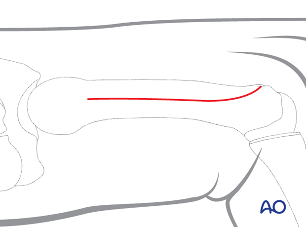 Skin incision of a dorsoulnar approach to the 5th metacarpal