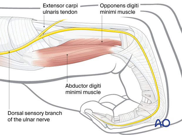 Ulnar view of the surgical anatomy at the 5th metacarpal and phalanges